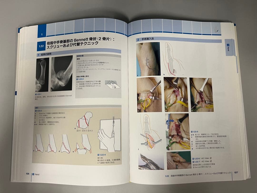 AO法 骨折治療 Hand and Wrist
